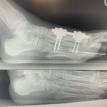 Surgical Repair of Shorten/Floating toe