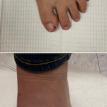 2 months post bunion surgery